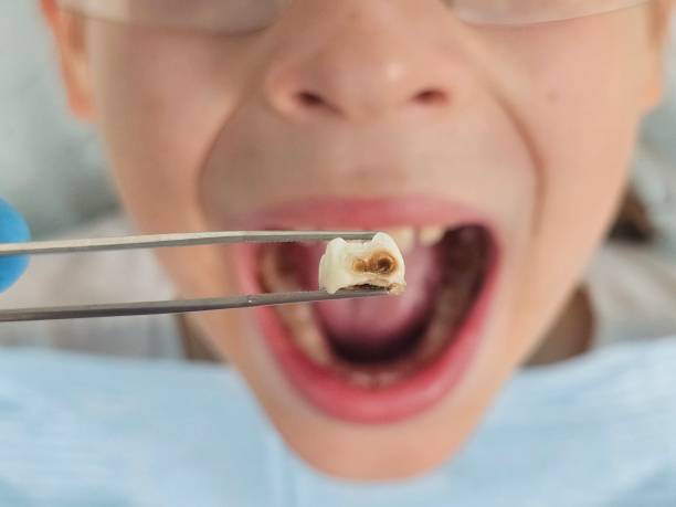 Best Emergency Wisdom Tooth Extraction in Marrero, LA